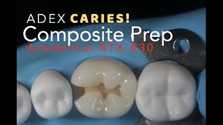 Class II Composite Preparation for ADEX Caries 30 MO [upl. by Hearsh]