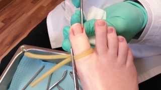 Ingrown toenail surgery [upl. by Ateuqal]