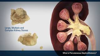 Percutaneous Nephrolithotomy PCNL [upl. by Olihs]