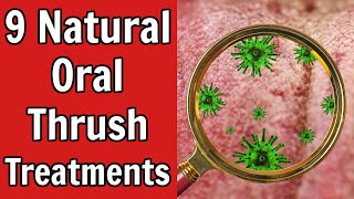 9 Natural Oral Thrush Treatments [upl. by Mikey840]