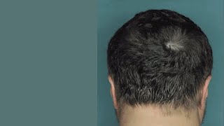 Drug Restores Hair Growth in Patients with Alopecia Areata [upl. by Carnay]