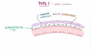 Membranoproliferative glomerulonephritis MPGN causes symptoms amp pathology [upl. by Diamond354]