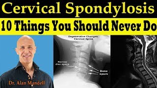 CERVICAL SPONDYLOSIS 10 Things You Should Never Do  Dr Alan Mandell DC [upl. by Yroffej106]