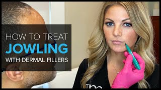 FAQ Bay Area Expert Shows How to Treat Jowls with Dermal Fillers [upl. by Alten]