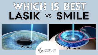 Laser Eye Surgery Lasik vs Smile  Dr ArulMozhi Varman  Uma Eye Clinic [upl. by Abbotson267]