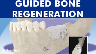 Guided bone regeneration  Bone graft © [upl. by Oicnecserc]