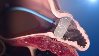 WATCHMAN Implantation Technique [upl. by Tindall]