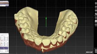 EXOCAD  Gingiva reduction guide design [upl. by Zinck662]