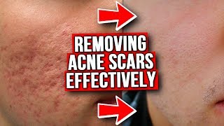 GET RID OF ACNE SCARS FROM EXPERIENCE [upl. by Eicyac819]