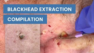 Extraction Satisfaction Blackhead Removal  CONTOUR DERMATOLOGY [upl. by Leuneb]