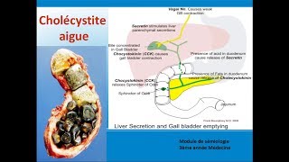 Cholécystite aiguë Cours de Hepato gastroenterologie [upl. by Akayas]