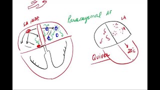 Atrial Fibrillation  Pathophysiology and Clinical [upl. by Assilav203]