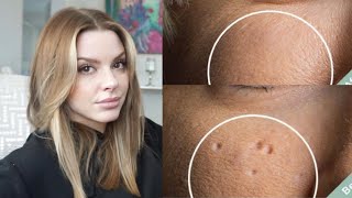 Esthetician Discusses How To Eliminate Pitted Acne Scars [upl. by Amelie]