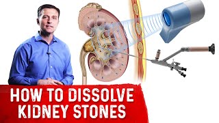 How To Dissolve Kidney Stones Explained By DrBerg [upl. by Sugirdor]