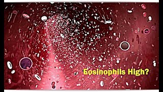 Eosinophils High Low – Causes [upl. by Eatnuahs288]