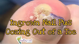 INGROWN NAIL PUS OOZING OUT OF A DIABETIC TOE  INFECTED INGROWN TOENAIL DIABETIC FOOT CARE [upl. by Ribaj]