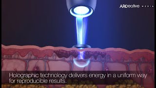 Acne Scars Removal  Picoway Resolve Teaser 3D Medical Device Animation [upl. by Wildermuth]