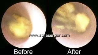 Sialendoscopic salivary gland stone lithotripsy and removal [upl. by Moser]