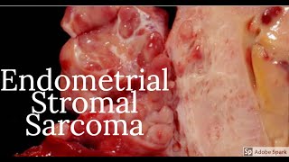 Digital Surgical Pathology 38 Endometrial Stromal Sarcoma [upl. by Newsom409]