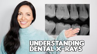 How To Understand Your Dental Xrays Dental Hygienist Explains [upl. by Shipp]