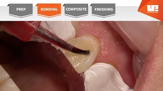 Bonding  Your Complete Restorative Solution [upl. by Sunil]