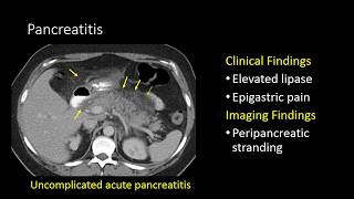 GI Imaging  Pancreatitis [upl. by Ardiedak43]