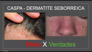 CASPA  DERMATITE SEBORREICA Mitos e Verdades  Com Luiz Gameiro dermatologista [upl. by Kittie481]