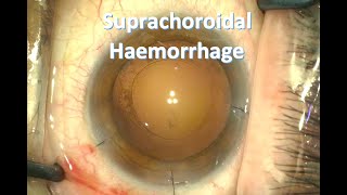 Penetrating Keratoplasty in Infectious Keratitis [upl. by Seugram]