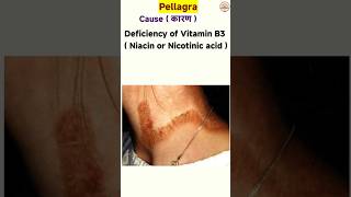 pellagra disease  niacin deficiency disease  skin diseases [upl. by Vladimar491]