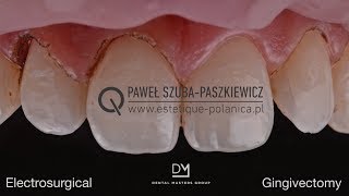 Electrosurgical Gingivectomy  Crown Lengthening [upl. by Berry]