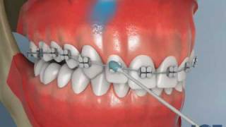 TAD Incisor Intrusion [upl. by Jegar]