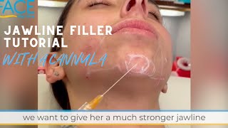 Jawline Filler and Chin Filler Cannula Tutorial [upl. by Eelik102]