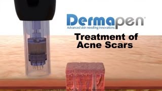 MicroNeedling for Acne Scars  Dermapen® Treatment [upl. by Scholem169]