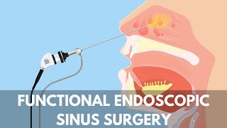 What is a Functional Endoscopic Sinus Surgery [upl. by Filberte405]