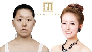 Korean Reconstructive Plastic Surgery Transformation  Seoul Guide Medical [upl. by Ury]