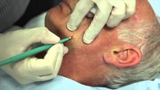 How to remove facial warts using Cautery [upl. by Zandra]