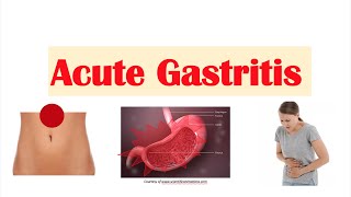 Acute Gastritis Stomach Inflammation  Causes Signs amp Symptoms Diagnosis Treatment [upl. by Nairda]