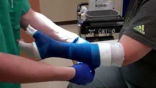 Application of a Thumb Spica Cast [upl. by Haneehs]