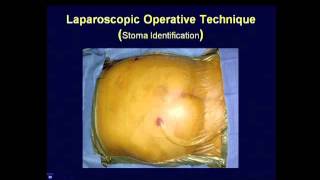 Parastomal Hernia Repair � Best Techniques Kristi Harold MD [upl. by Josy930]