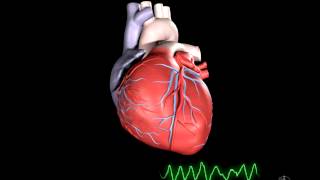 What is Ventricular Fibrillation [upl. by Portingale]