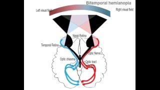 Bitemporal hemianopia [upl. by Aicittel]