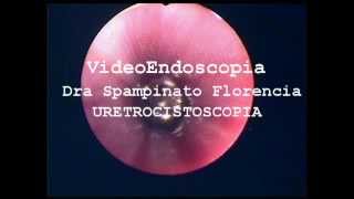 URETROCISTOSCOPIA Emma Neoplasia vesical VideoEndoscopia Dra Spampinato Florencia [upl. by Aysab145]