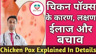 ChickenPox  Doctor Explains  Chickenpox  Food to Eat amp Food to Avoid  Mera Doctor [upl. by Aeki]