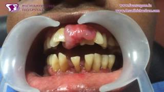 Massive Epulis Removal Treatment  Dental Videos showing Oral Surgery [upl. by Ecilahs]