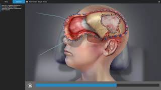 Traumatic Brain Injury  Brain Surgery Animation [upl. by Dawes112]