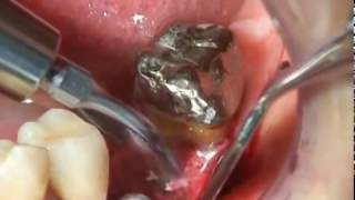 Piezotome Extraction of Fractured Root Using LC1 [upl. by Arinaid]