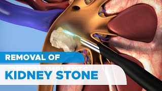 Removal of Kidney Stones Percutaneous Nephrolithotomy PCNL for Kidney Stones [upl. by Stalder]