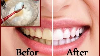 DIY Teeth Whitening at Home in 2 minutes [upl. by Nedrah888]