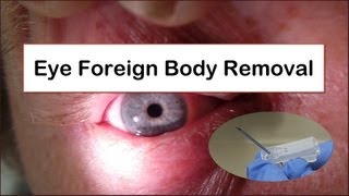 Eye Foreign Body Removal [upl. by Callie]