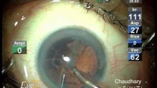 Micro incision cataract surgery MICS by phaco at Eye7 Delhi India [upl. by Cilka]